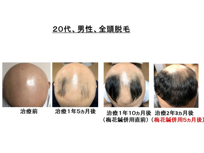 円形脱毛症　病院